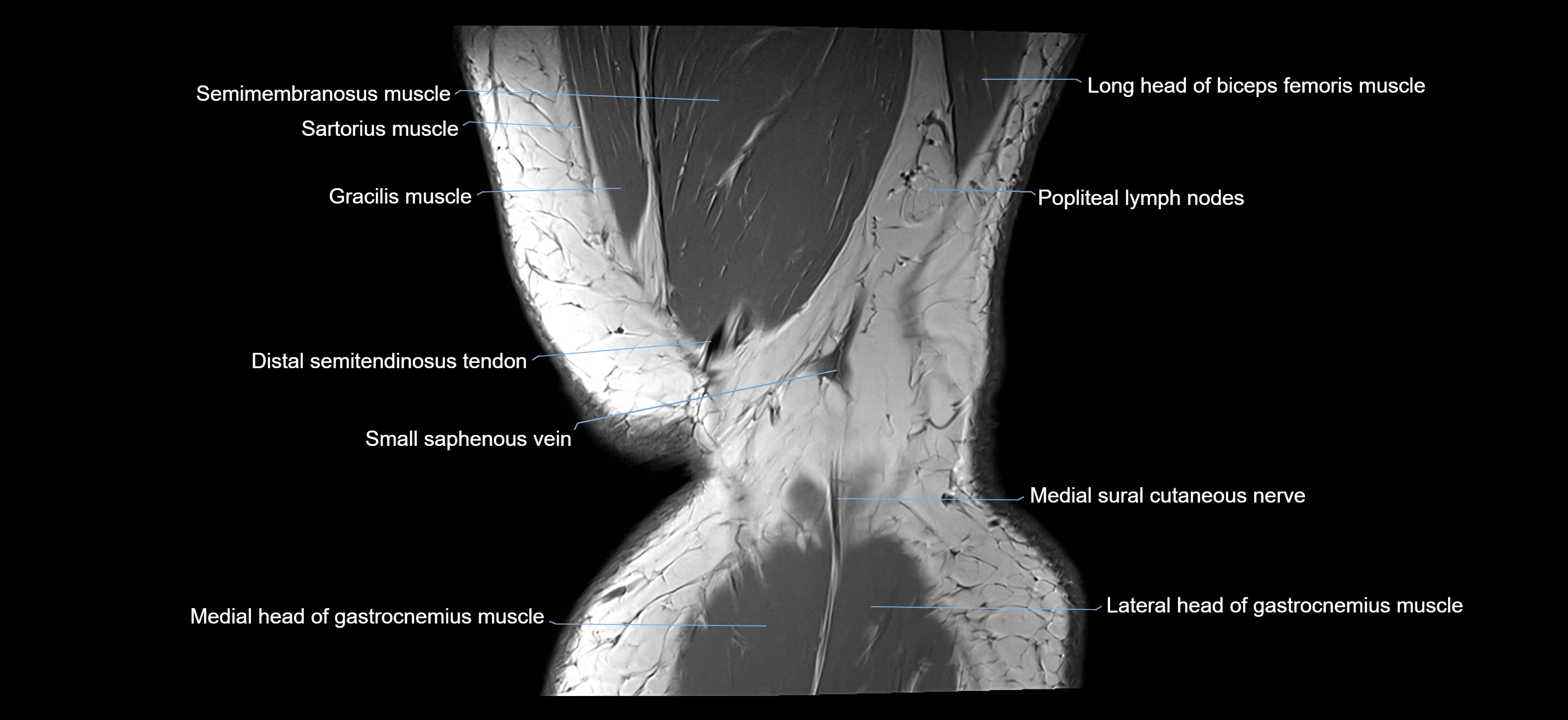 MRI knee coronal cross sectional anatomy labelled 3T radiology  image-04001-00043.webp